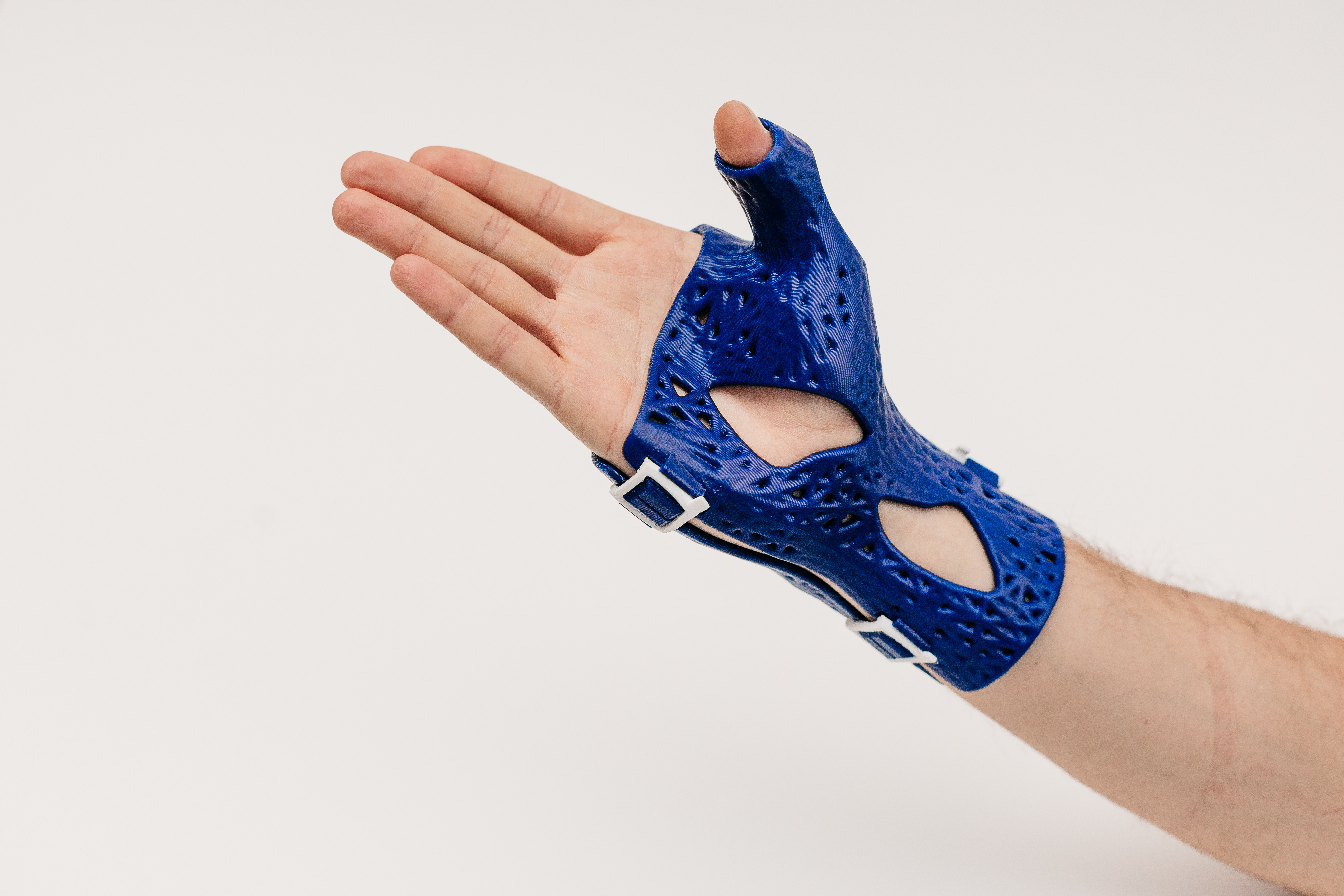 Klīnikā pieejama kaulu lūzumu ārstēšana ar 3D printētu CastPrint ģipsi